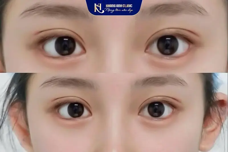 Cắt mí mắt tỷ lệ vàng