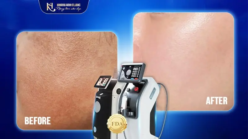Trước & Sau Điều Trị Sạm Da
