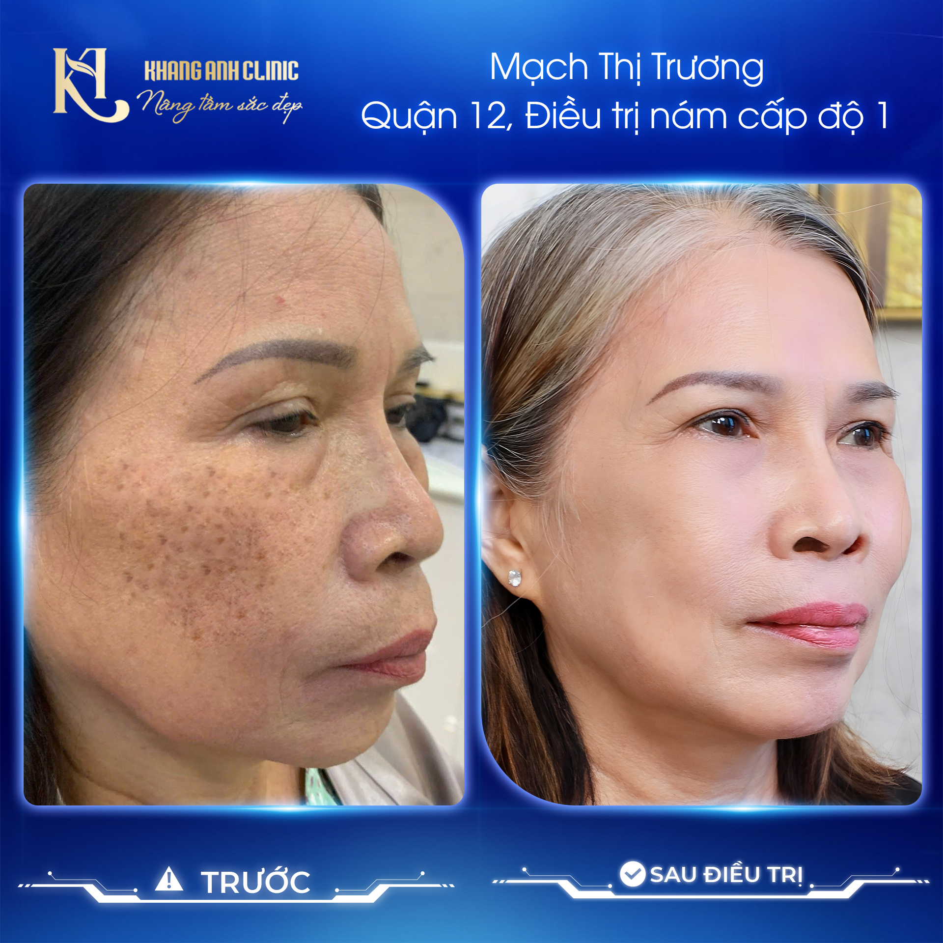 hình ảnh trước và sau khi điều trị nám