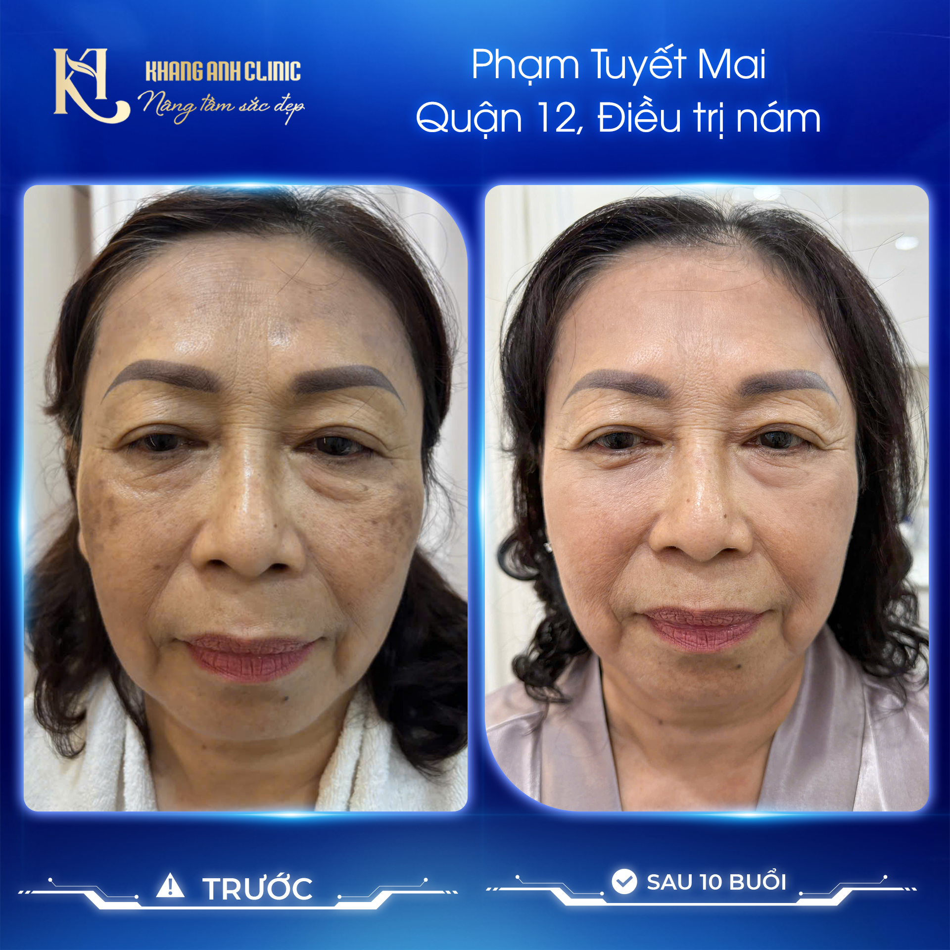 hình ảnh trước và sau khi điều trị nám