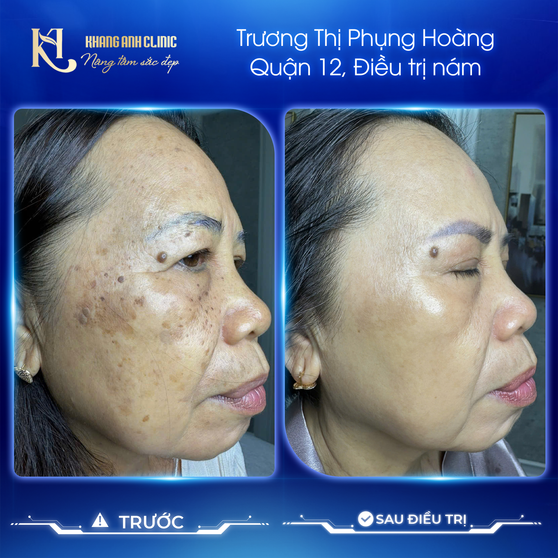hình ảnh trước và sau khi điều trị nám