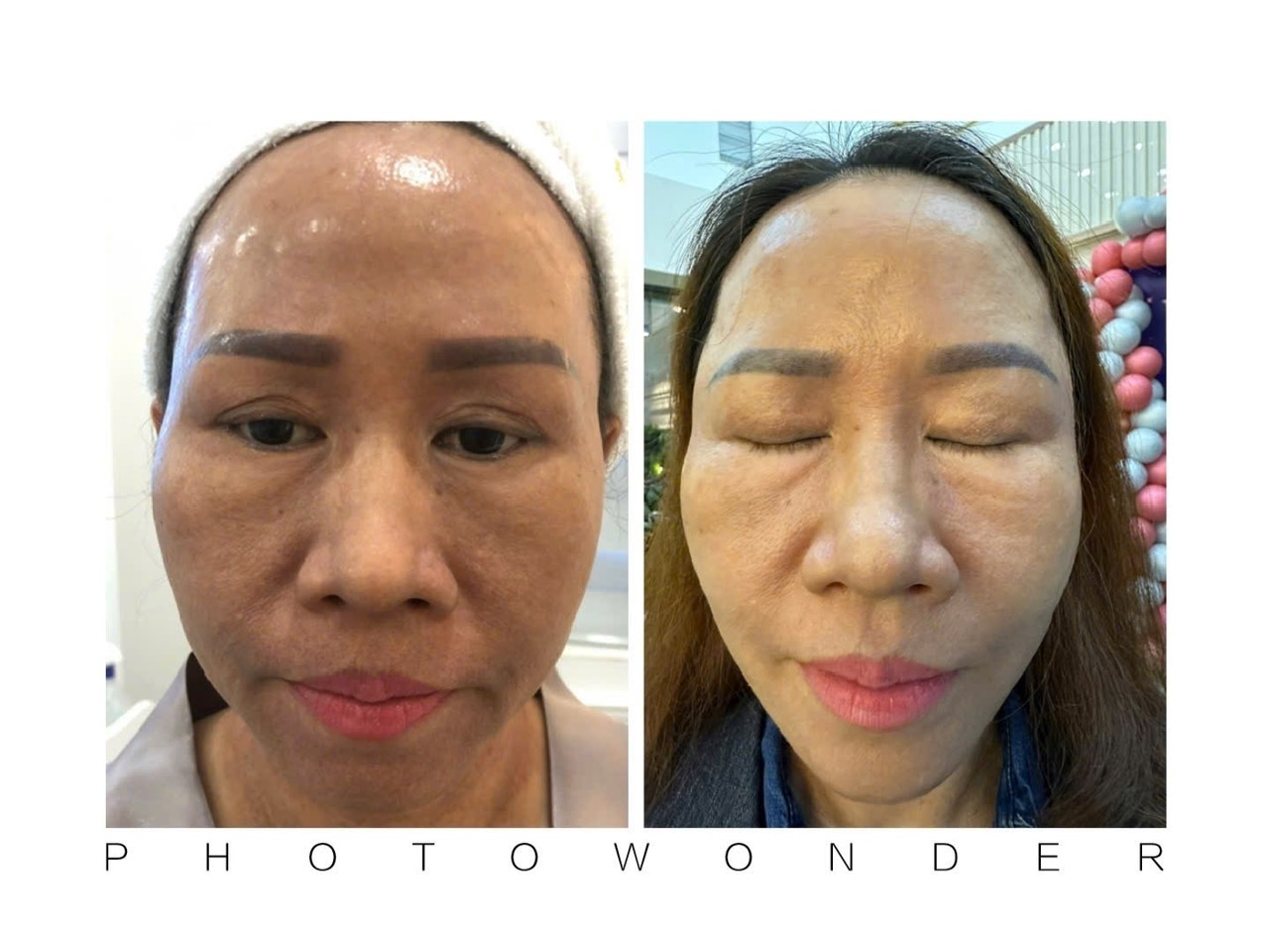 Da không đều màu