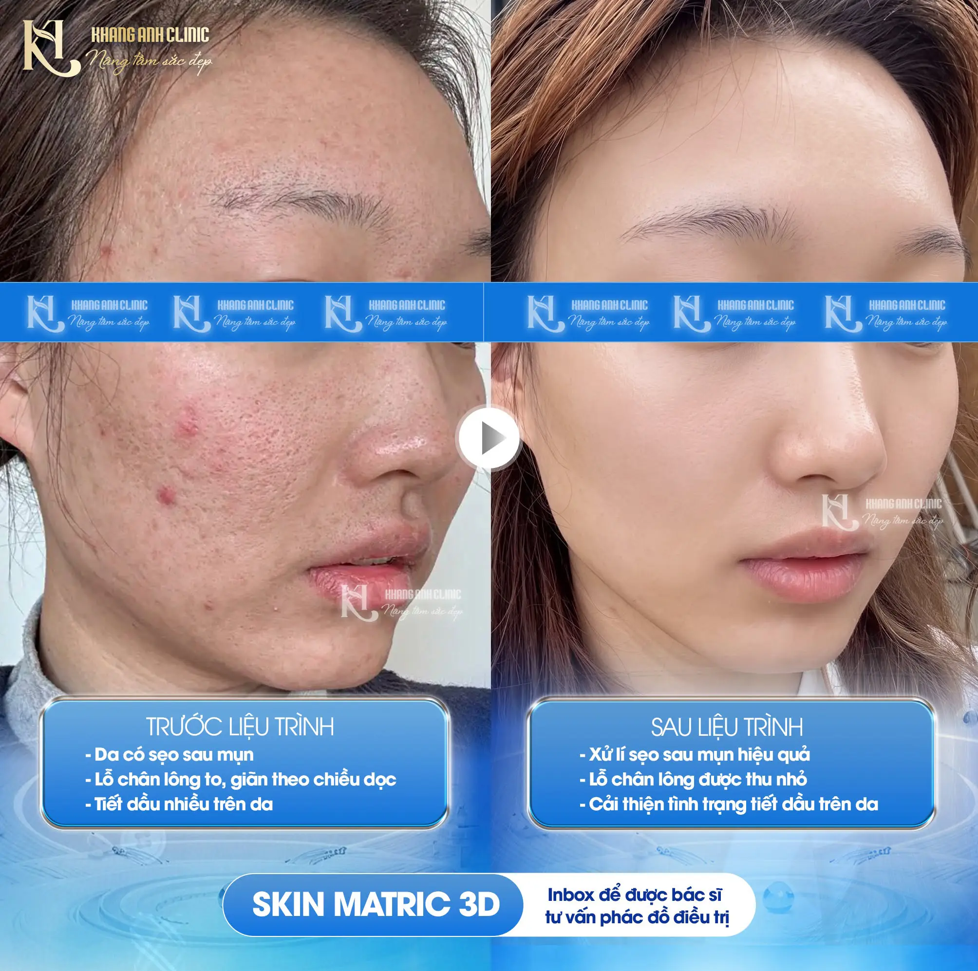 Kết quả Skin Matrix 3D 1