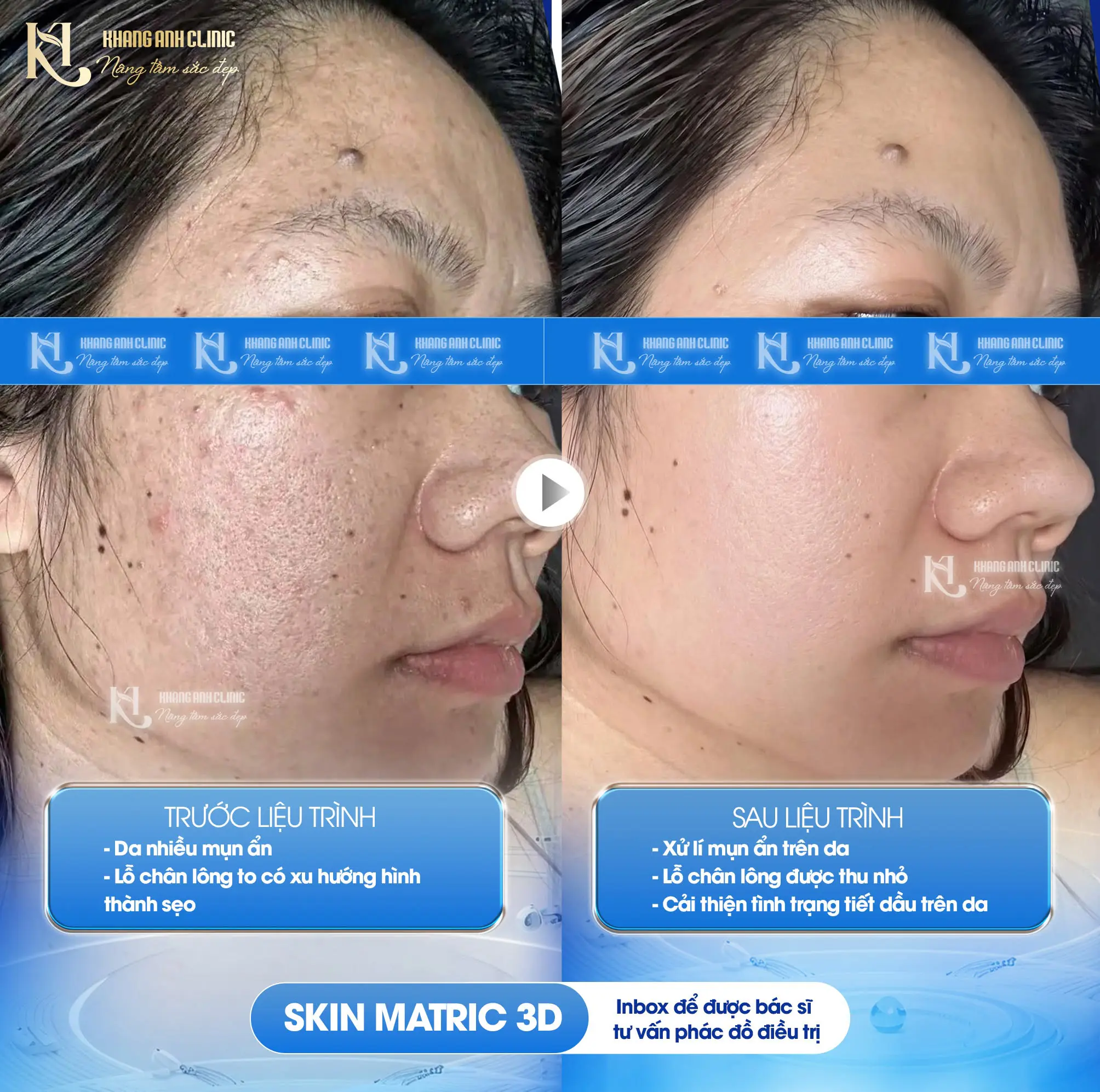 Kết quả Skin Matrix 3D 2