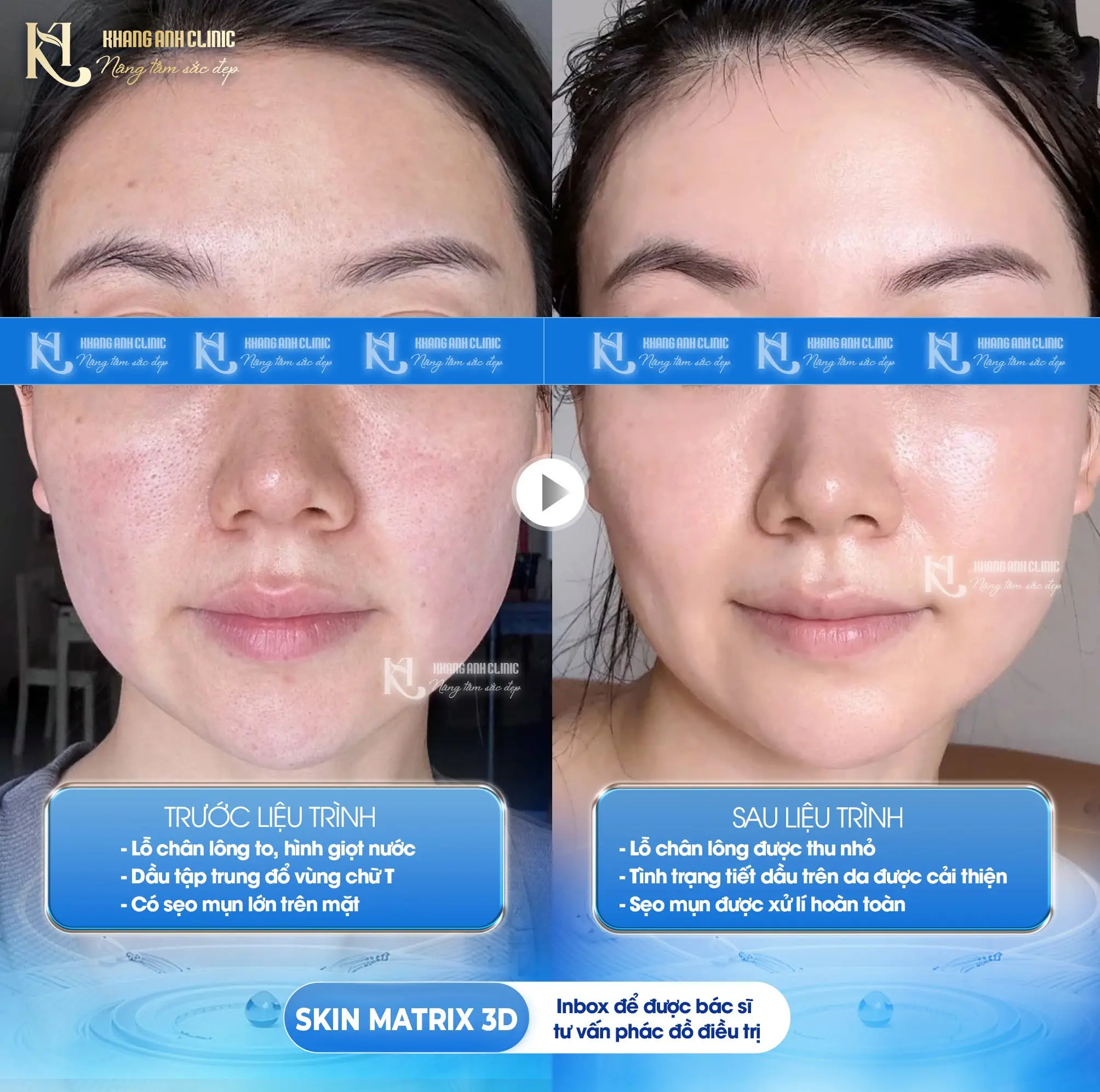 Kết quả Skin Matrix 3D 3