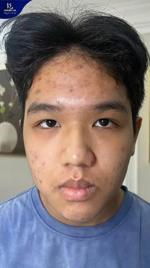ipl trị mụn, ipl điều trị mụn, ipl