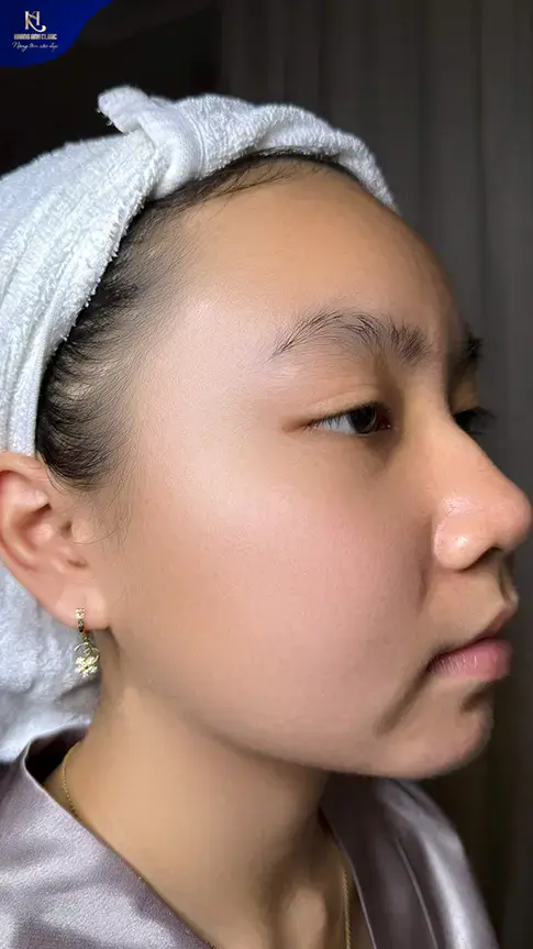 ipl trị mụn, ipl điều trị mụn, ipl