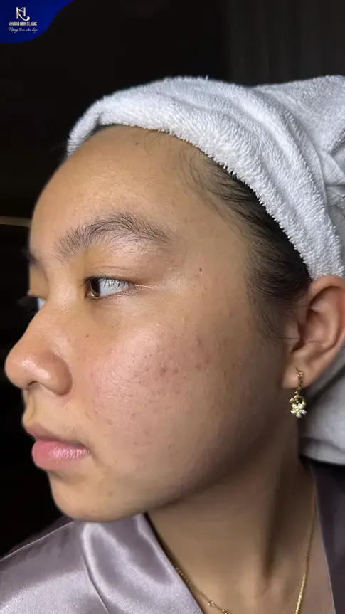 ipl trị mụn, ipl điều trị mụn, ipl