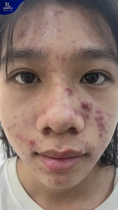 ipl trị mụn, ipl điều trị mụn, ipl