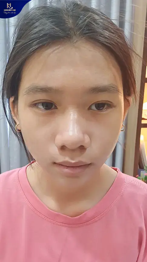 ipl trị mụn, ipl điều trị mụn, ipl