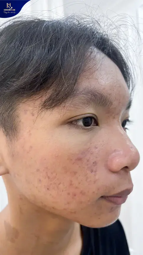 ipl trị mụn, ipl điều trị mụn, ipl