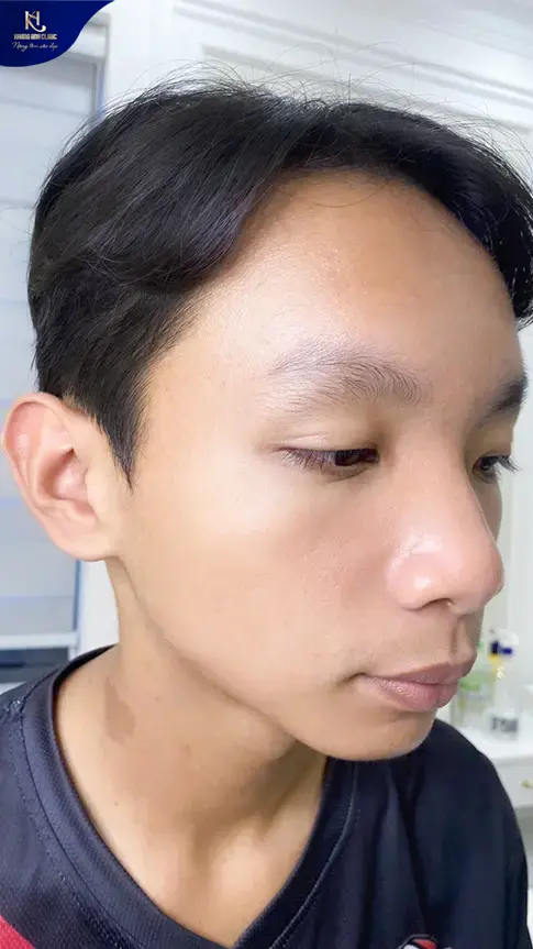 ipl trị mụn, ipl điều trị mụn, ipl