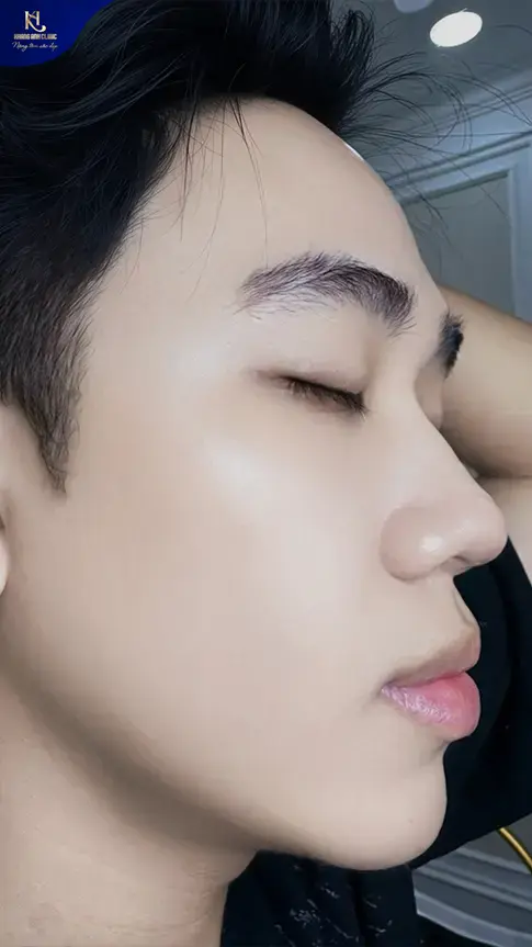 ipl trị mụn, ipl điều trị mụn, ipl