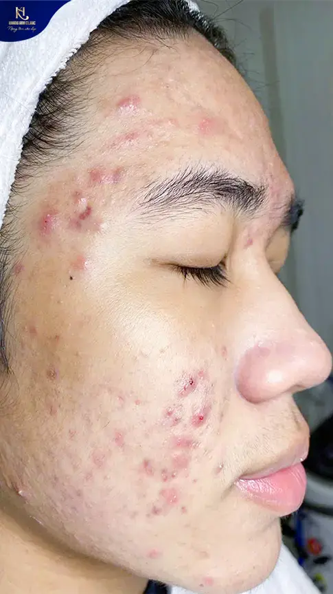 ipl trị mụn, ipl điều trị mụn, ipl