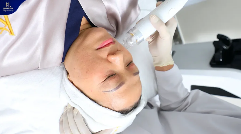 điều trị tàn nhang bằng laser, điều trị tàn nhang bằng laser bao nhiêu tiền