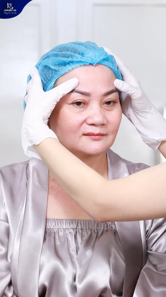 phẫu thuật căng da mặt bao lâu thì đẹp, phẫu thuật căng da mặt