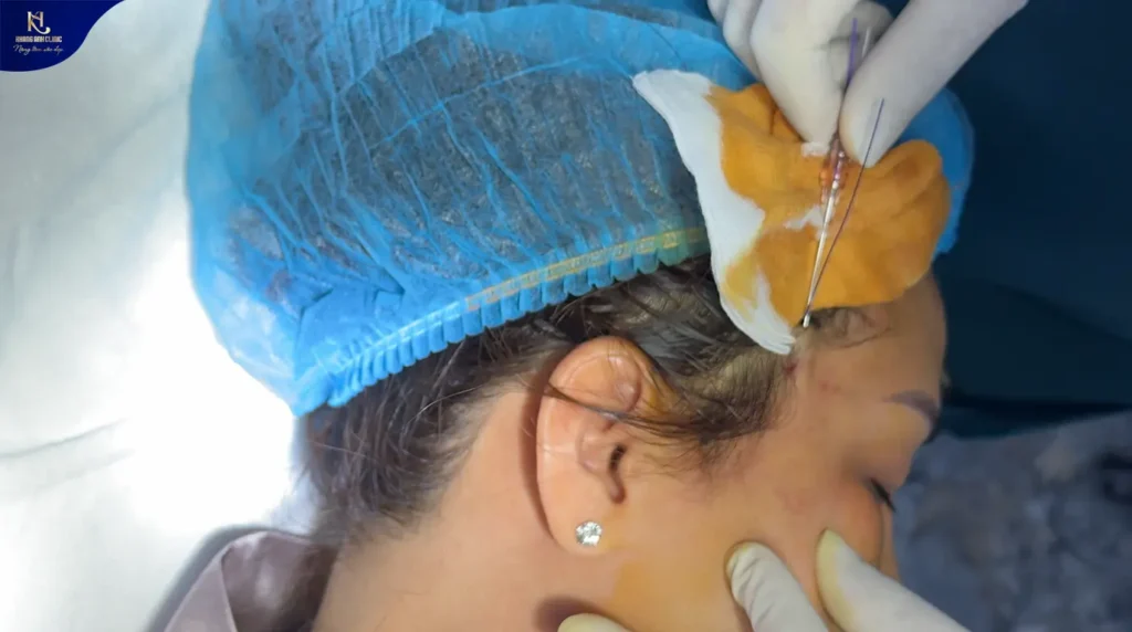 phẫu thuật căng da mặt bao lâu thì đẹp, phẫu thuật căng da mặt