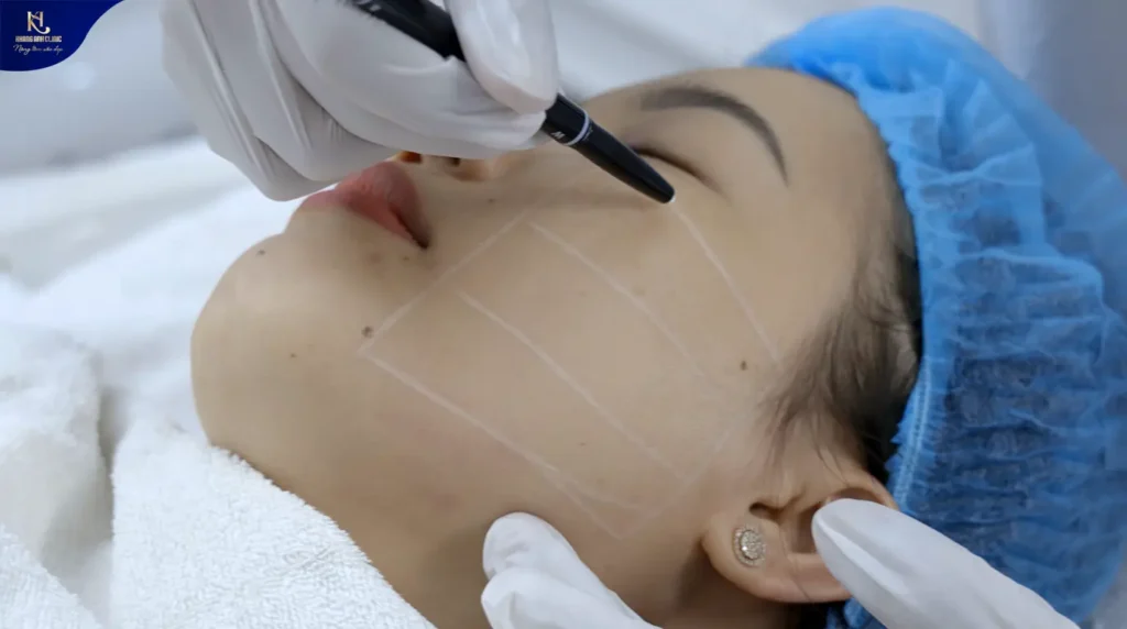 căng da mặt bao nhiêu tiền, căng da mặt giá bao nhiêu
