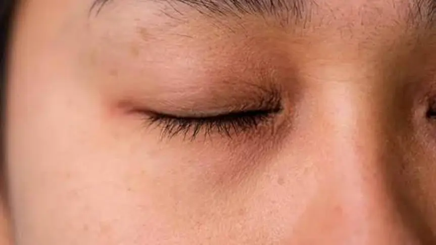 hình ảnh mặt bị tàn nhang