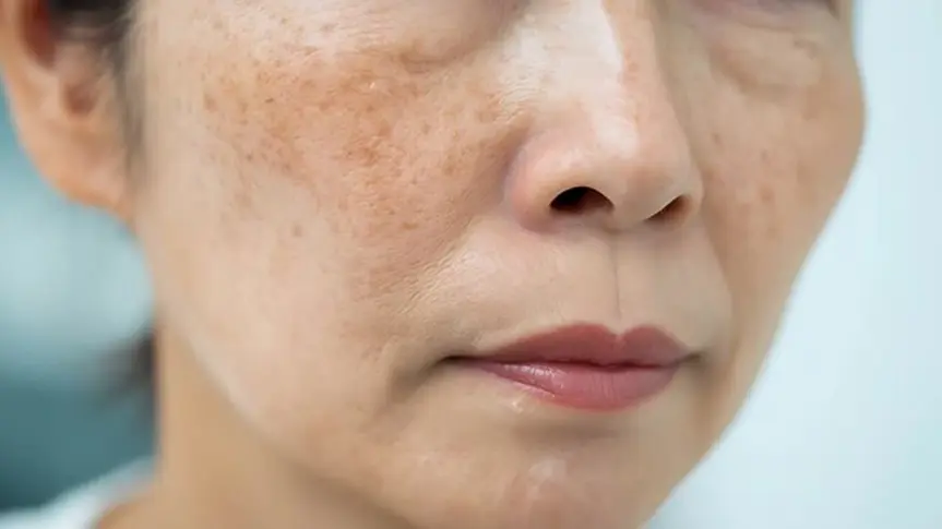hình ảnh mặt bị tàn nhang