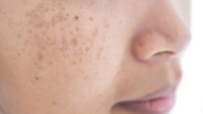 hình ảnh mặt bị tàn nhang