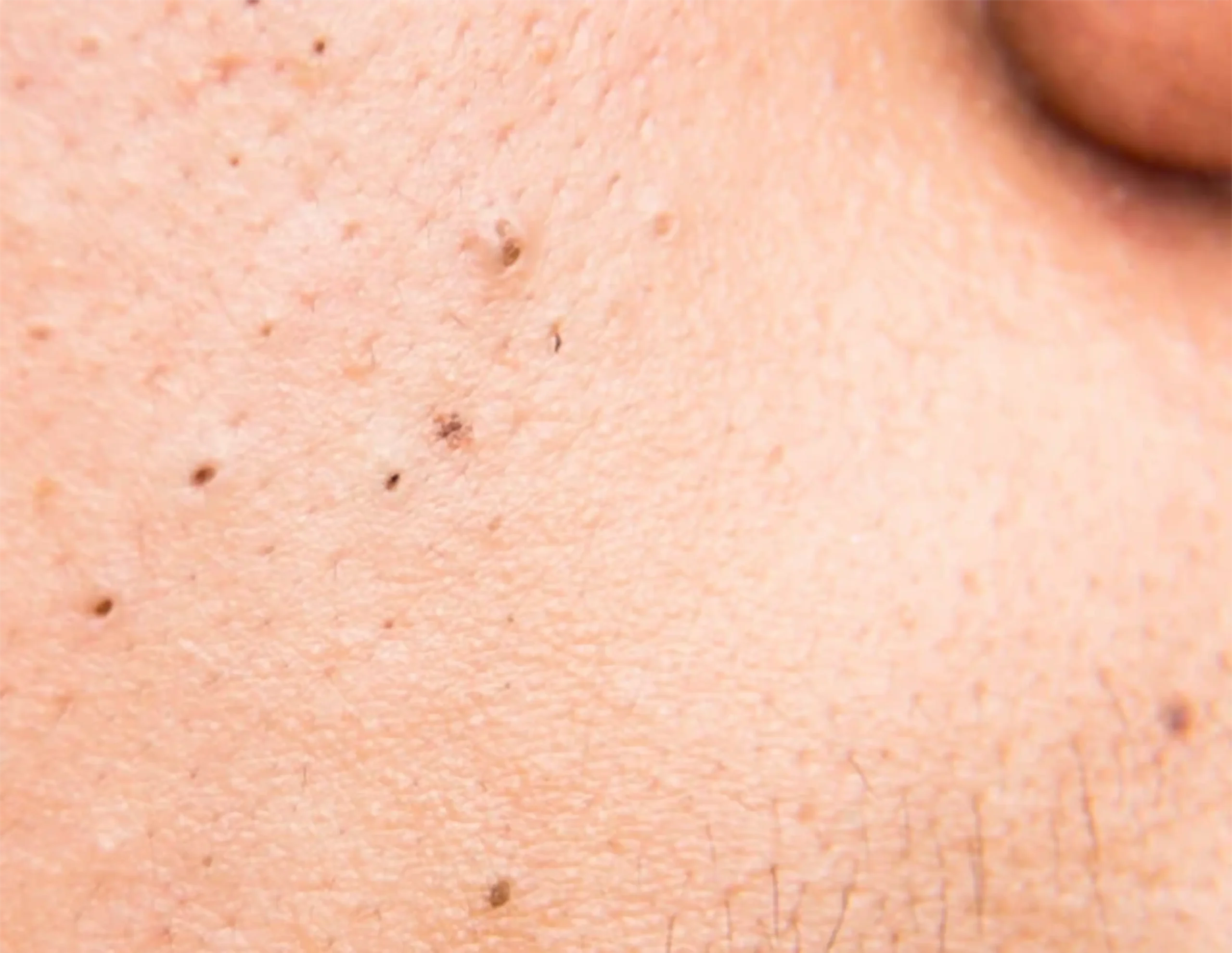 cách trị mụn đầu đen ở mũi hiệu quả