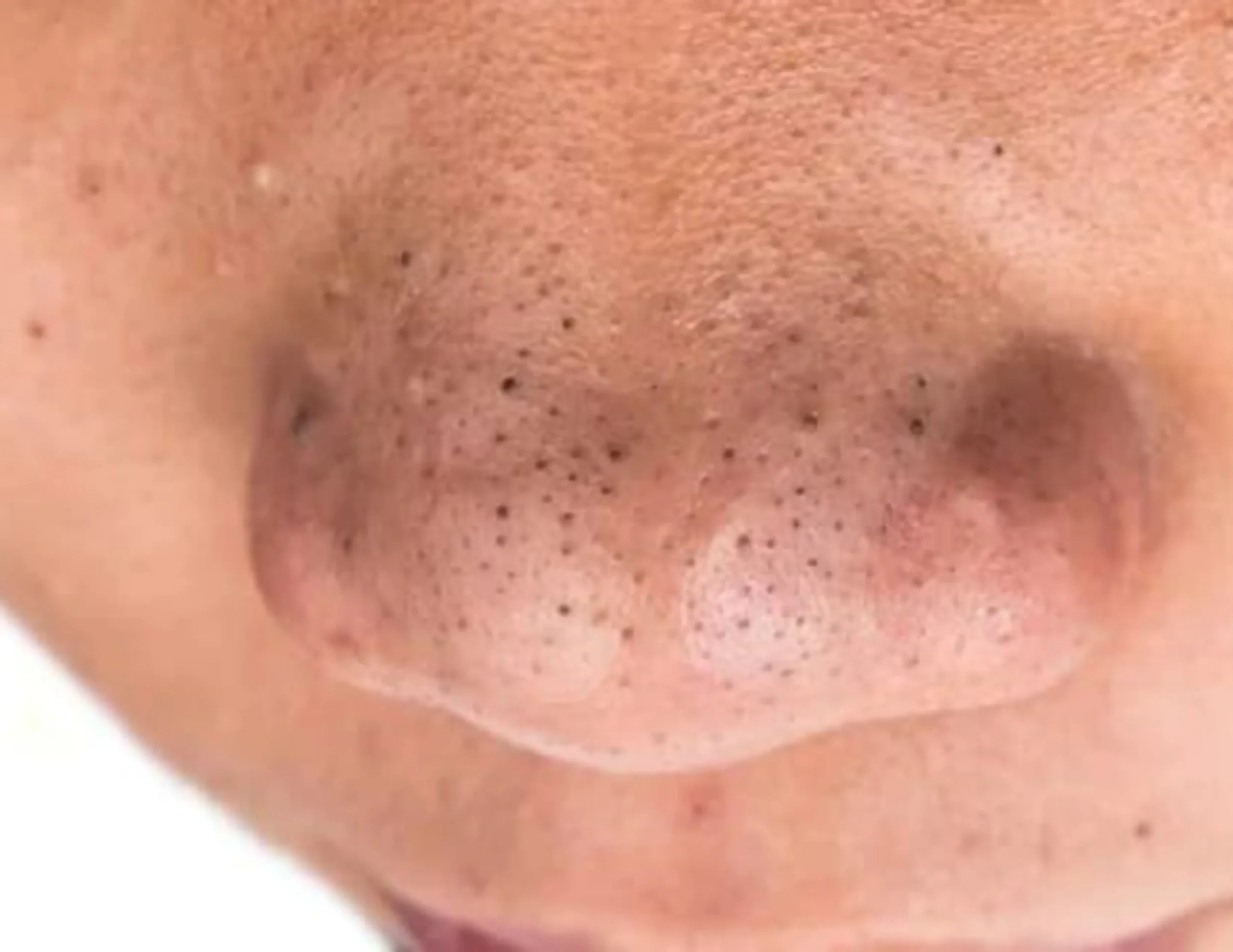 cách trị mụn đầu đen ở mũi hiệu quả