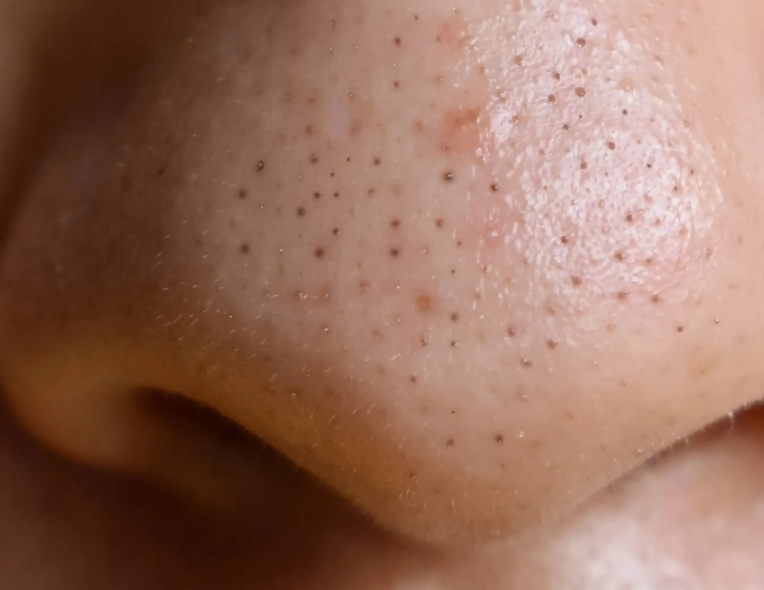 cách trị mụn đầu đen ở mũi hiệu quả