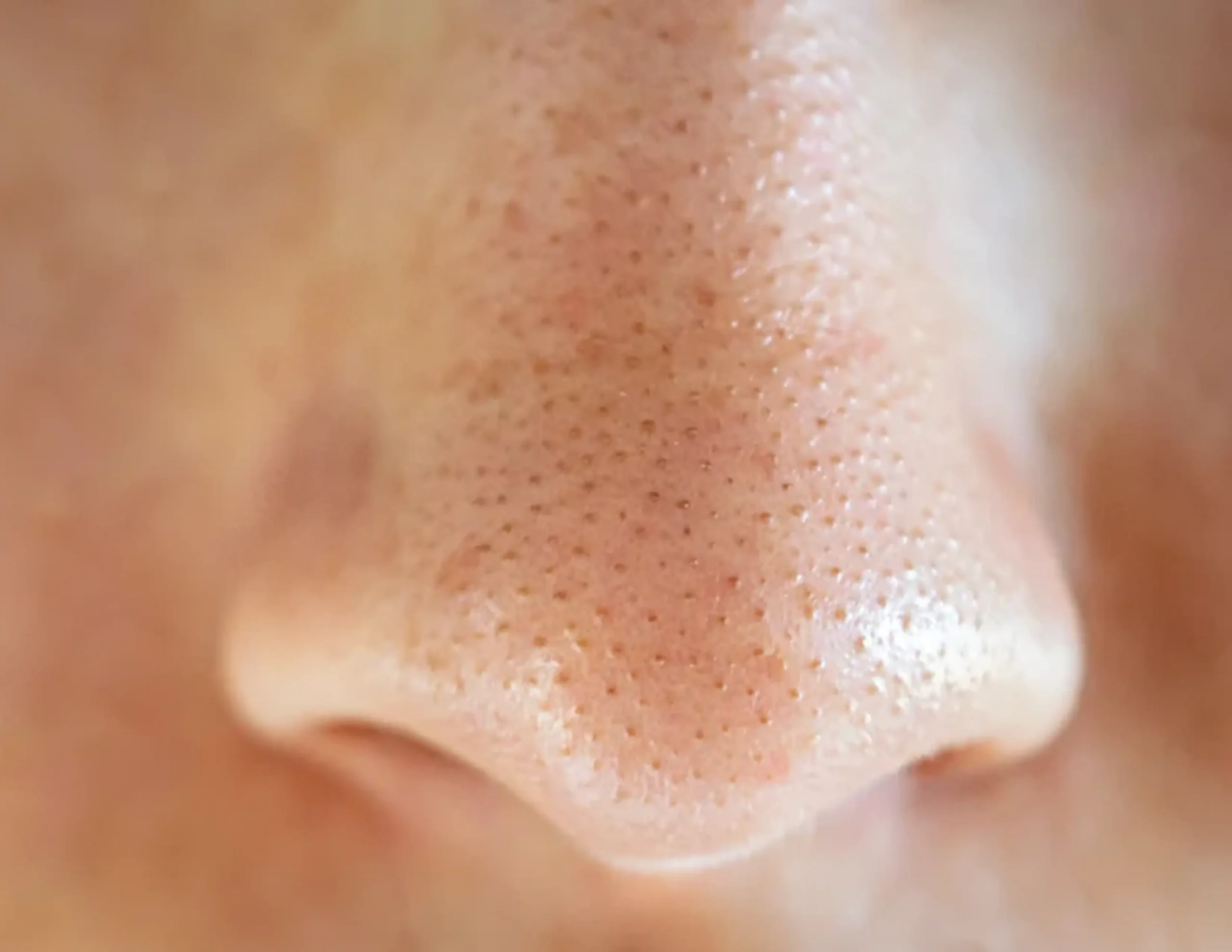cách trị mụn đầu đen ở mũi hiệu quả