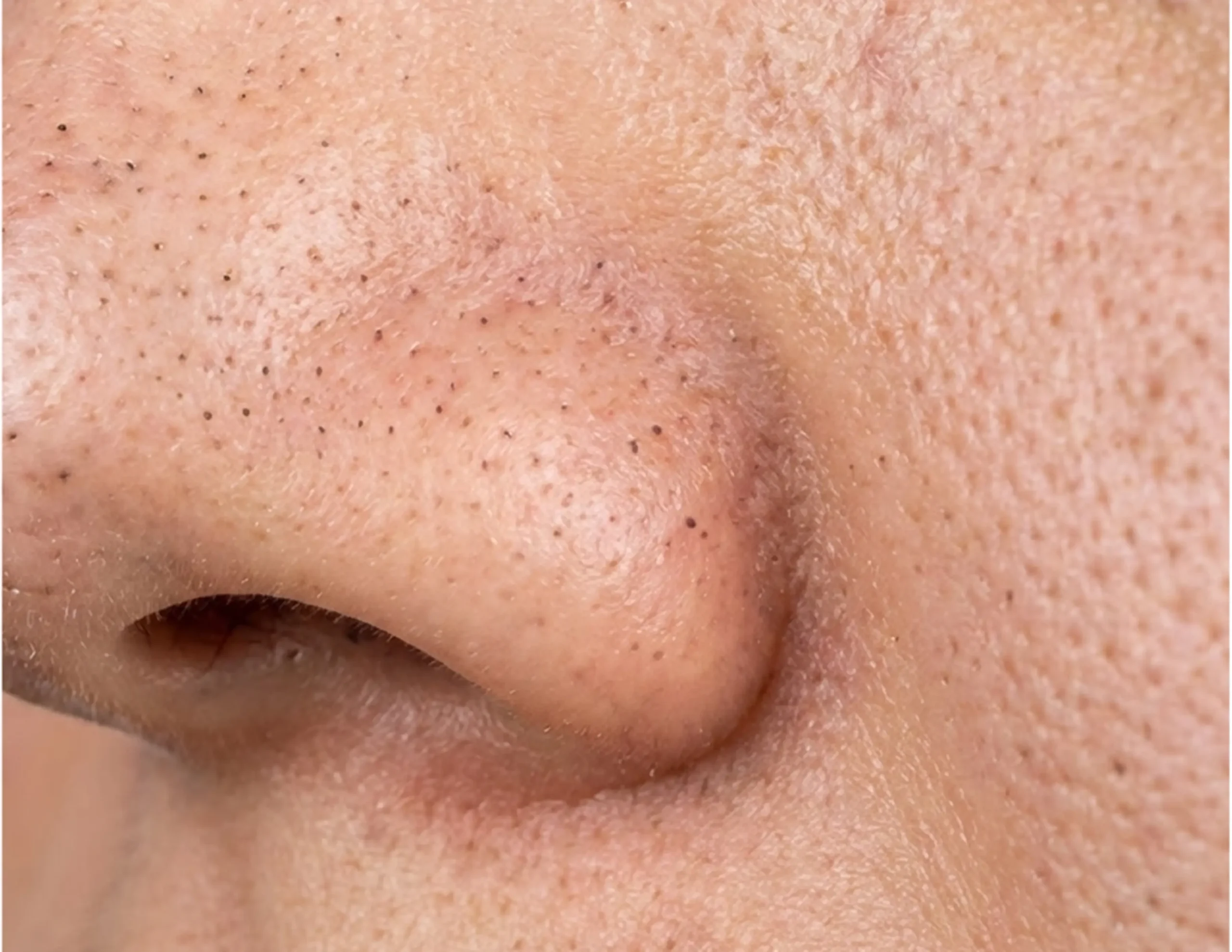cách trị mụn đầu đen ở mũi hiệu quả