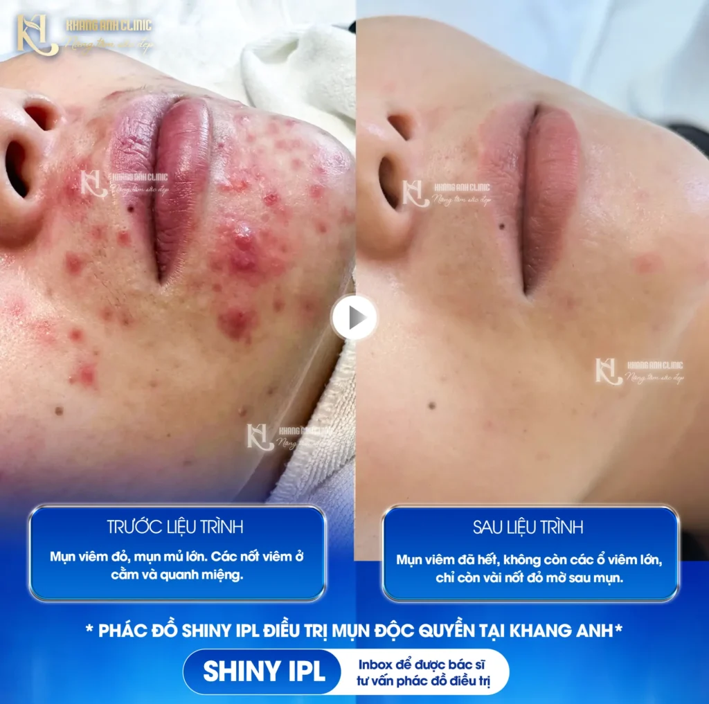 mụn dưới cằm