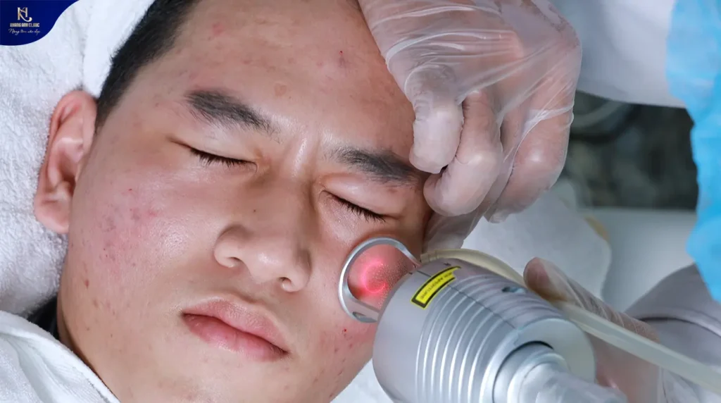 lỗ chân lông to và sẹo đáy nhọn, sẹo đáy nhọn và lỗ chân lông to