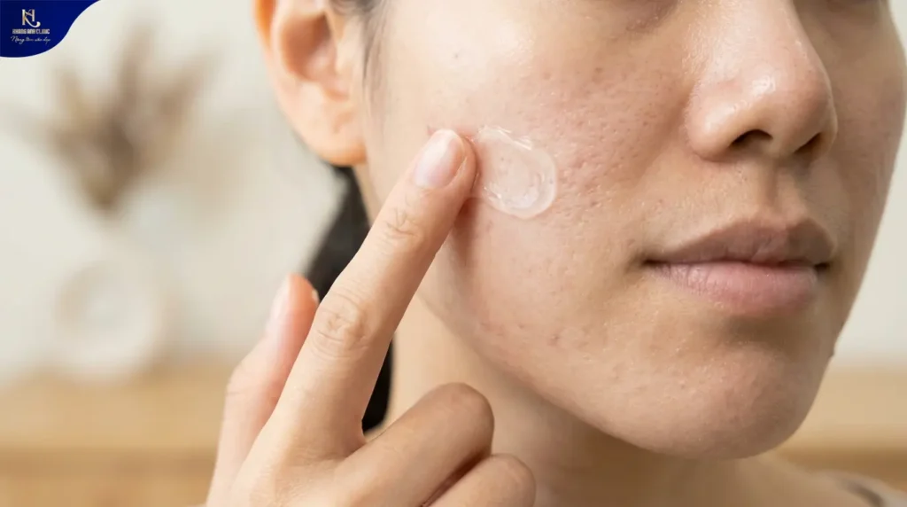mụn 2 bên má do đâu, mụn 2 bên má