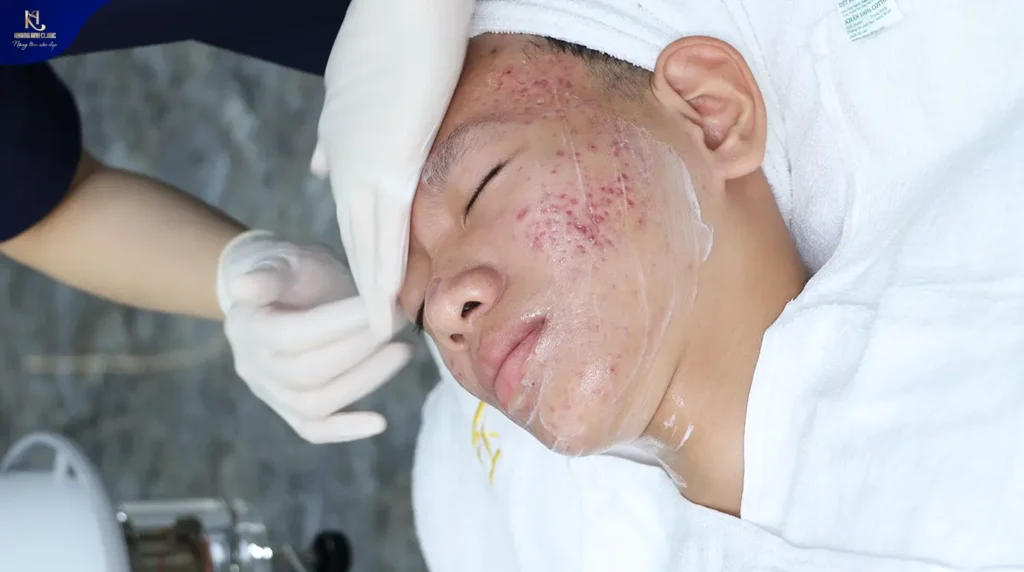 mụn trứng cá tuổi dậy thì, các loại mụn thường gặp ở tuổi dậy thì, thuốc trị mụn trứng cá tuổi dậy thì, cách trị mụn trứng cá ở tuổi dậy thì